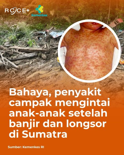 Bahaya, Penyakit Campak Mengintai Anak-Anak Setelah Banjir dan Longsor di Sumatra